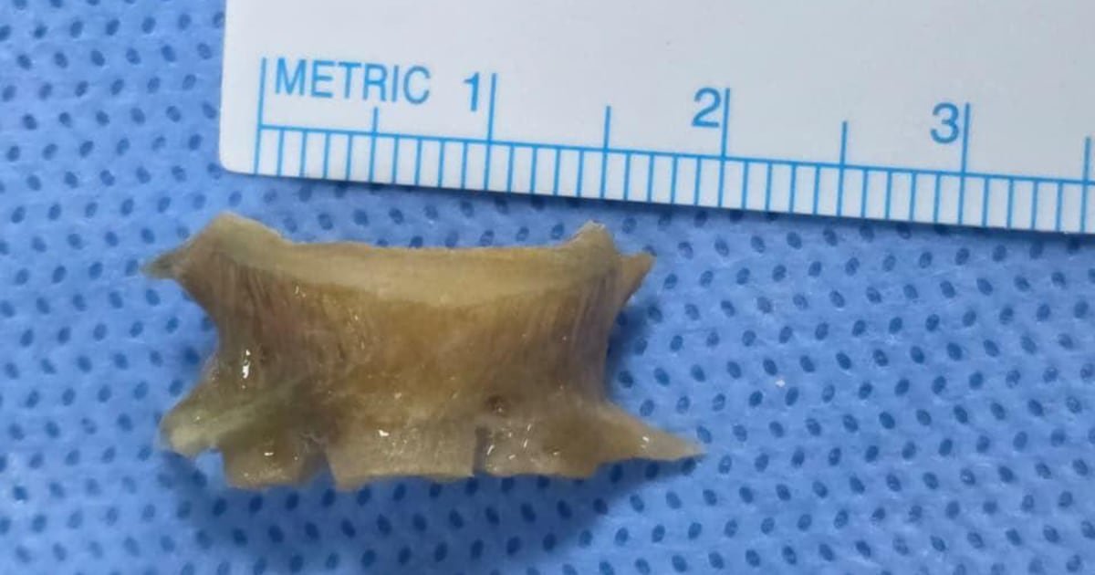 أطباء في دبي يستخرجون عظمة سمك عمرها شهرين من مجرى تنفس رجل